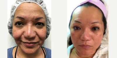 Microneedling before and after photo