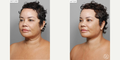 Neck Lift before and after photo