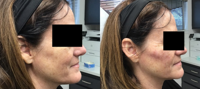 Restylane before and after photo