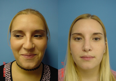 Rhinoplasty before and after photo
