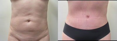 Tummy Tuck before and after photo