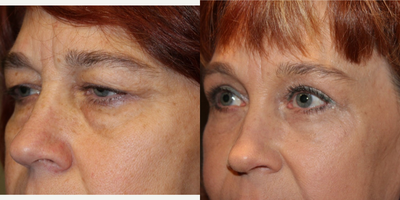 Brow Lift before and after photo