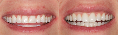 Dental Bonding before and after photo