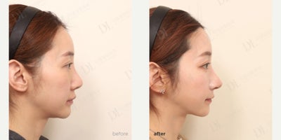 Facelift before and after photo