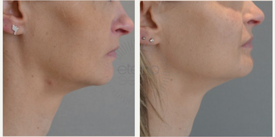 Juvederm before and after photo