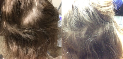 PRP for Hair Loss before and after photo