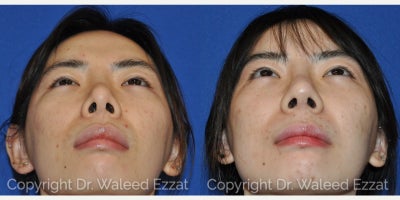 Revision Rhinoplasty before and after photo
