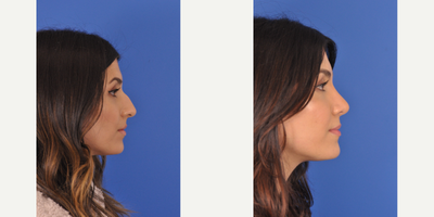 Rhinoplasty before and after photo