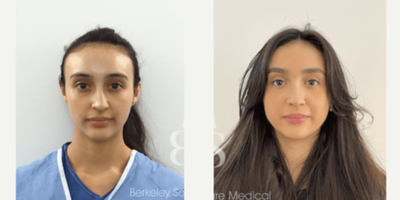 Septoplasty before and after photo