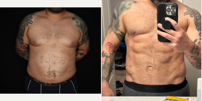 Vaser Liposuction before and after photo