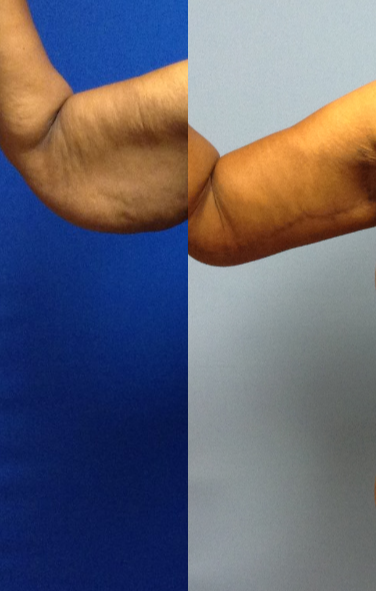 Arm Lift before and after photo