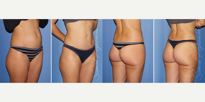 Brazilian Butt Lift before and after photo
