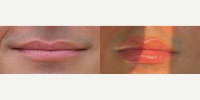 Dermal Fillers before and after photo