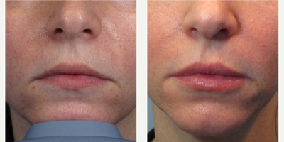 Juvederm before and after photo