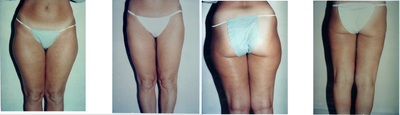 Liposuction before and after photo