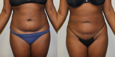 Power-Assisted Liposuction (PAL) before and after photo