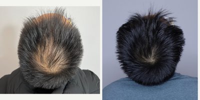 PRP for Hair Loss before and after photo