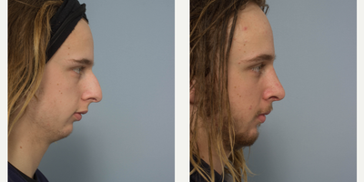Rhinoplasty before and after photo