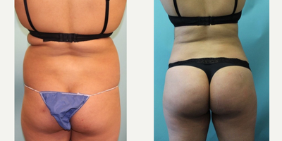 Smart Lipo before and after photo