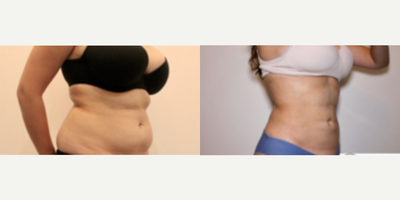 Tummy Tuck before and after photo