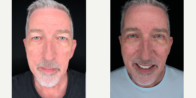 Eyelid Surgery before and after photo
