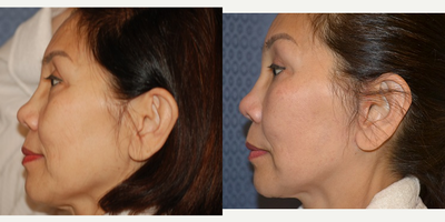 Facelift before and after photo