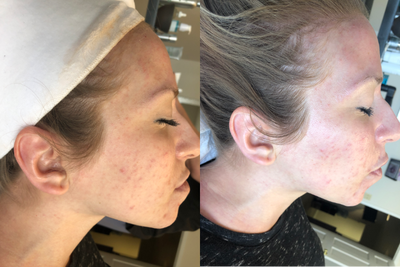 Facial before and after photo