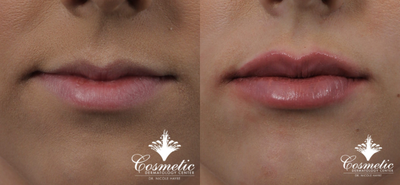Lip Fillers before and after photo