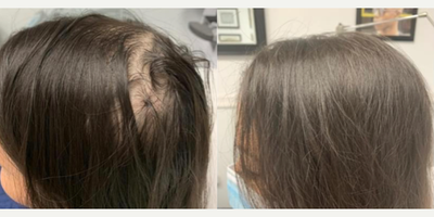 PRP for Hair Loss before and after photo