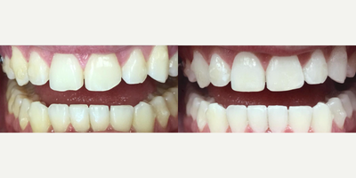 Teeth Whitening before and after photo