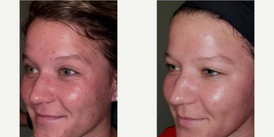 Chemical Peel before and after photo