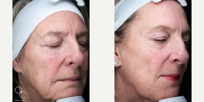 CO2 Laser before and after photo