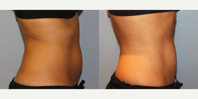 CoolSculpting before and after photo