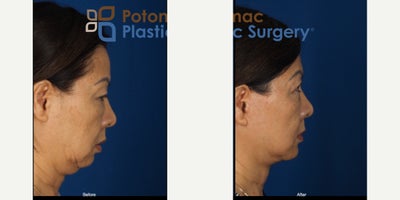 before and after image