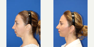 Eyelid Surgery before and after photo