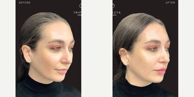 Juvederm before and after photo