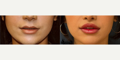 Lip Lift before and after photo