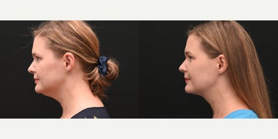 Neck Lift before and after photo
