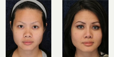 Rhinoplasty before and after photo