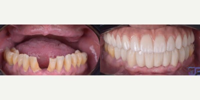 Smile Makeover before and after photo
