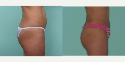 Tummy Tuck before and after photo