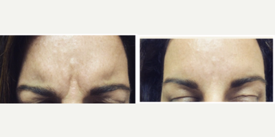 Dysport before and after photo