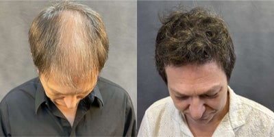 Hair Loss Treatment before and after photo
