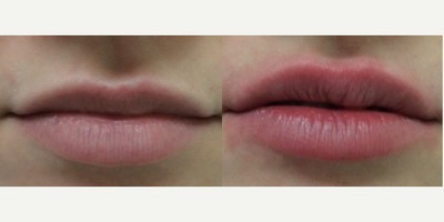 Lip Fillers before and after photo
