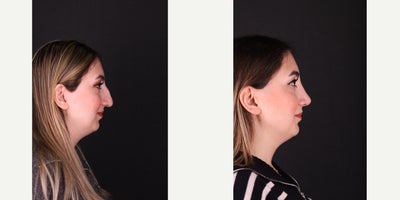 Rhinoplasty before and after photo