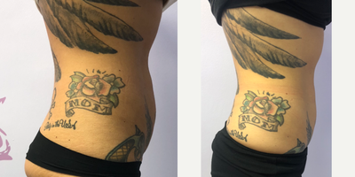 SculpSure before and after photo