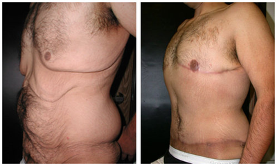 Body Lift before and after photo
