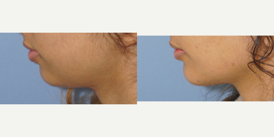 Chin Implant before and after photo