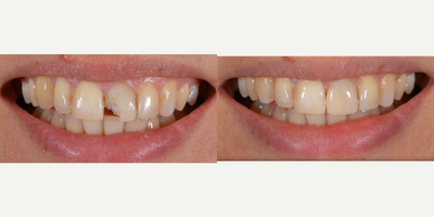Dental Bonding before and after photo
