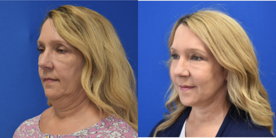 Facelift before and after photo